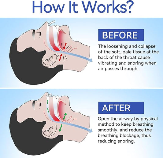 Anti Snoring Devices, Anngola Snoring Solution, Silicone Magnetic Anti Snoring Nose Clip, Effective Hale Breathing Aid, Stop Snoring to Restful Sleep(10 Pack)