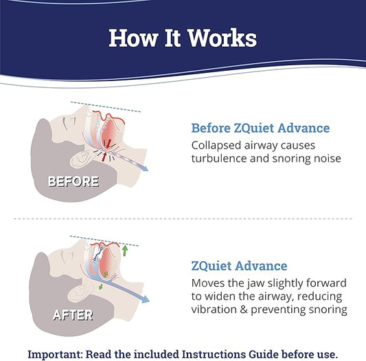 ZQuiet, Advance, Custom Anti-Snoring Mouthpiece, Adjustable Mouthguard with 4 Jaw Advancement Sizes, Slim & Low-Profile, Clear