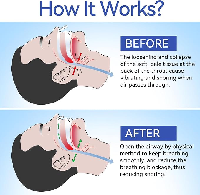Anti Snoring Devices, Anngola Snoring Solution, Silicone Magnetic Anti Snoring Nose Clip, Effective Hale Breathing Aid, Stop Snoring to Restful Sleep(10 Pack)