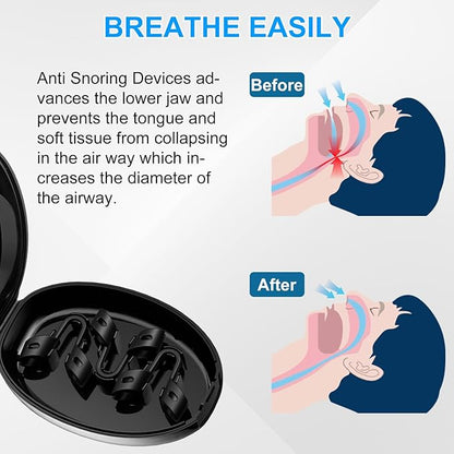 Anti Snoring Devices, Nasal Dilator for Sleeping, Effective to Relieve Snoring, for Nasal Snorers, Reusable Snoring Device to Enjoy a Peaceful Night's Sleep - 3 Pack (S)
