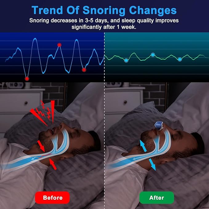 Anti Snoring Device - Mini SleepApnea Devices - Variable Anti Snoring Aid - Upgraded Stop Snoring Solution - Suitable for All Nose Shapes - Blue - P7
