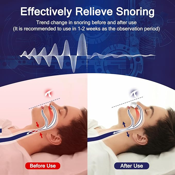 Electric Anti Snore Device, Adjustable Wind Speed Snoring Solution, Mini Anti Snoring Devices Nose Vents Plugs,Stop Snoring for Men & Women