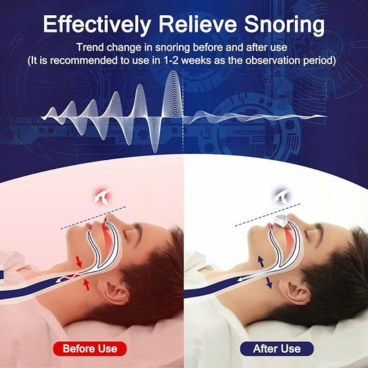Electric Anti Snore Device, Adjustable Wind Speed Snoring Solution, Mini Anti Snoring Devices Nose Vents Plugs,Stop Snoring for Men & Women