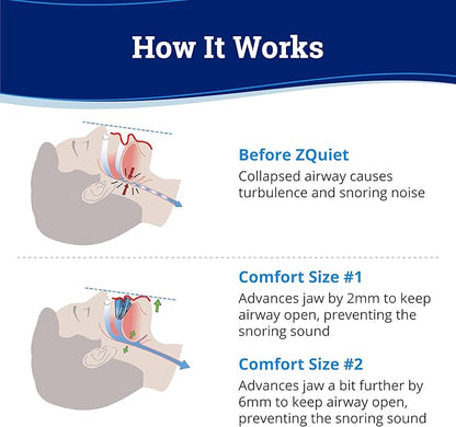 ZQuiet Anti-Snoring Mouthpiece Solution, 2 Size Comfort System Starter Kit + Nasal Dilator (2 Pack / 30 Day Supply) - Made in USA & FDA Cleared