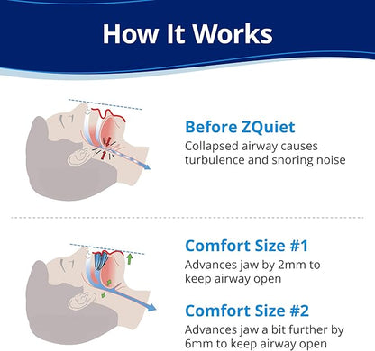 ZQuiet, Anti-Snoring Mouthpiece, Starter Pack with 2 Sizes, Living Hinge & Open Front Design for Comfort & Easy Breathing, Blue