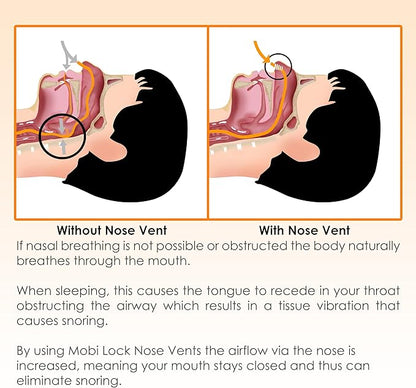 Nose Vent Sinus Relief (Pack of 12 Various Types and Sizes) - A Simple Solution for Nasal Snorers - Reusable Snoring Device to Enjoy a Peaceful Night's Sleep - by Mobi Lock