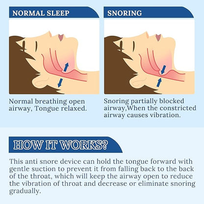 Snoring Solution - Anti-Snore Device, Reusable Snore Solution Stopper for Men/Women - MF25